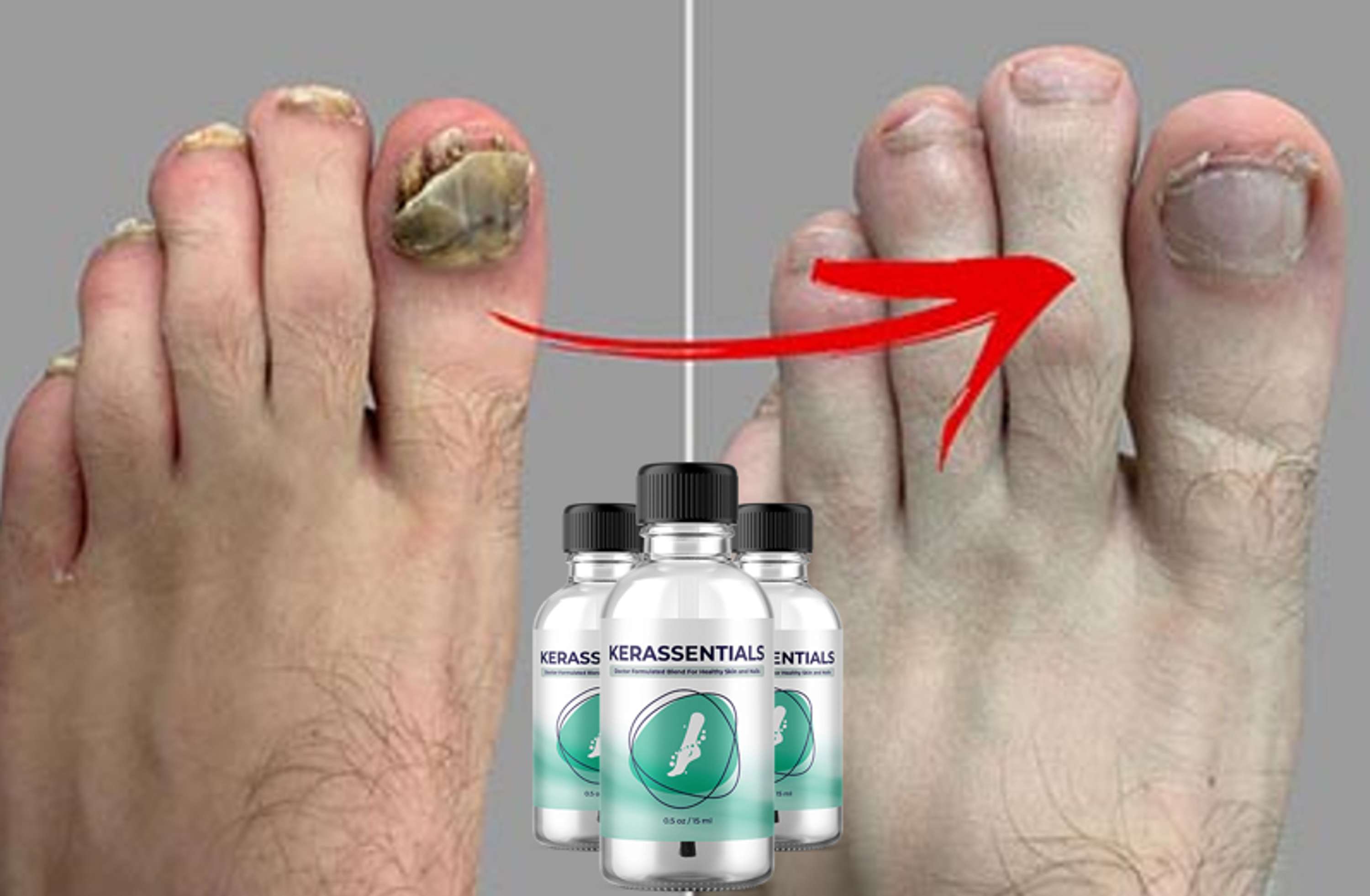 Kerassentials Nails Care by Fungus Care