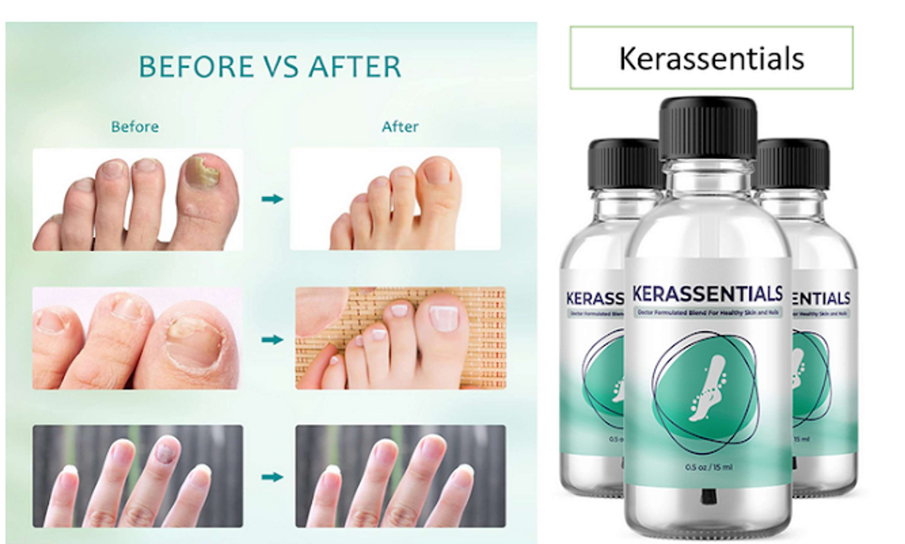 Kerassentials reviews: DOCTOR-FORMULATED SUPPLEMENT THAT WORKS? by Christopher Westphal