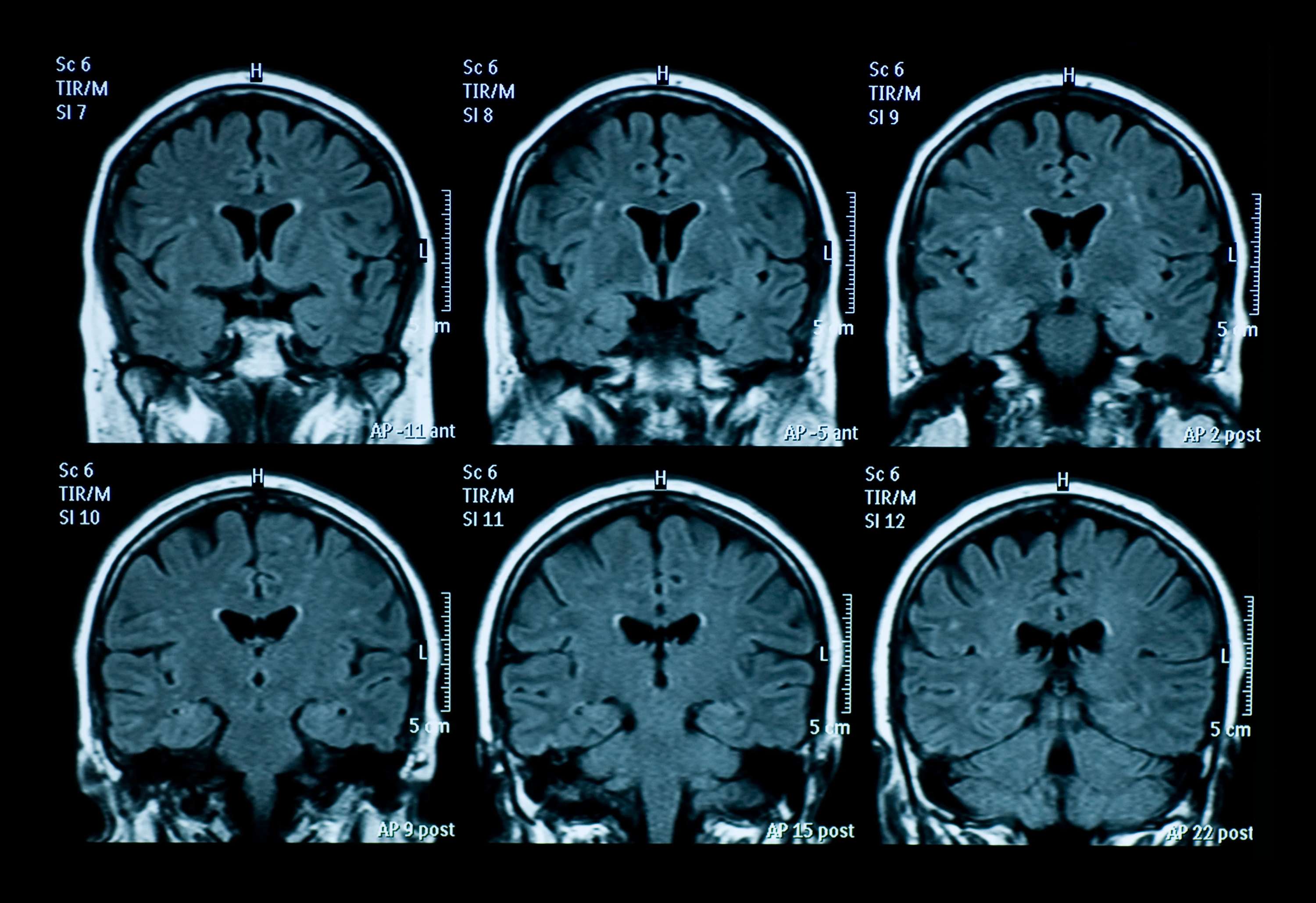 Why MRI Scan Has Been Done by MedMatch Network