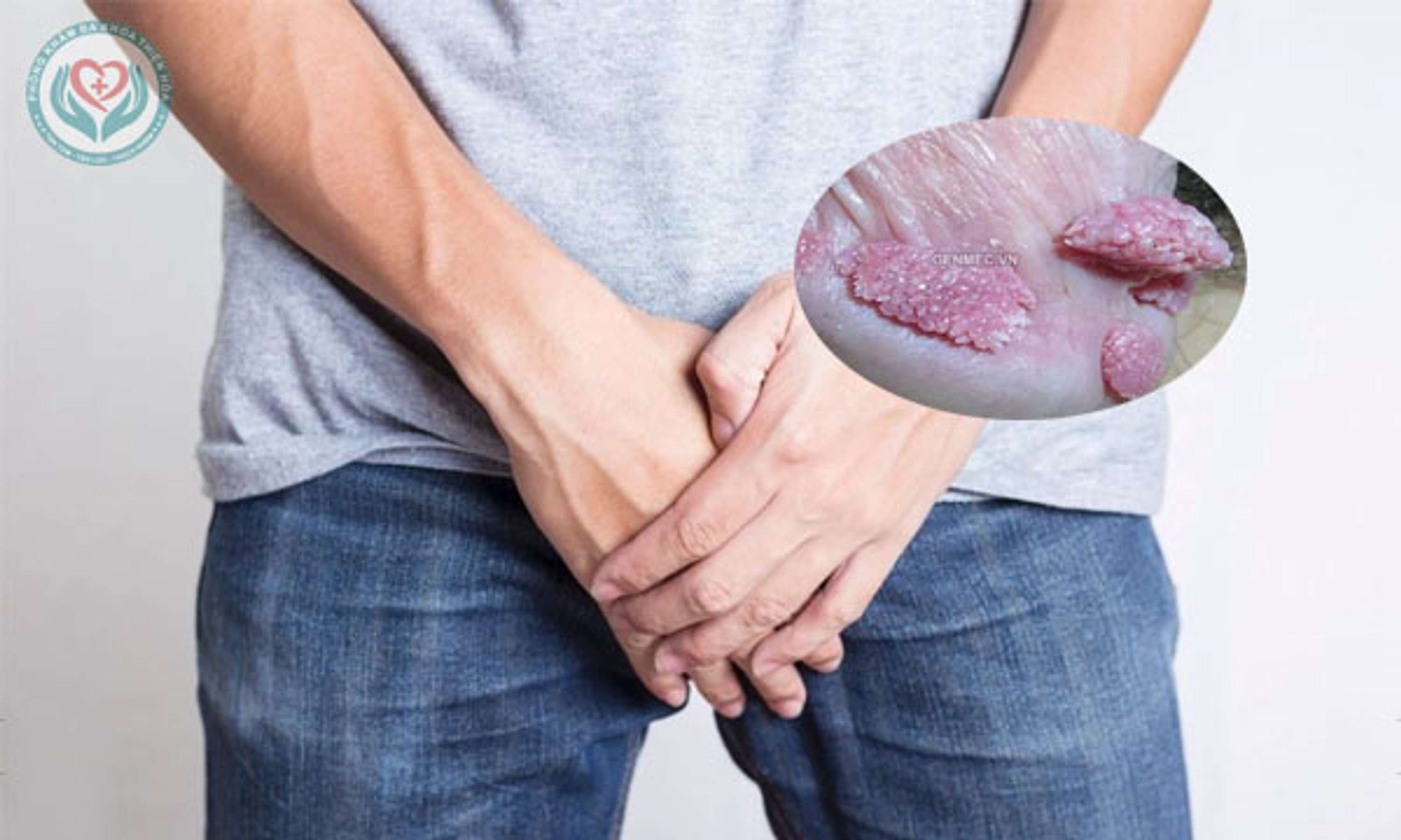 Bệnh sùi mào gà ở nam giới và những thông tin cần lưu ý by Phòng Hòa