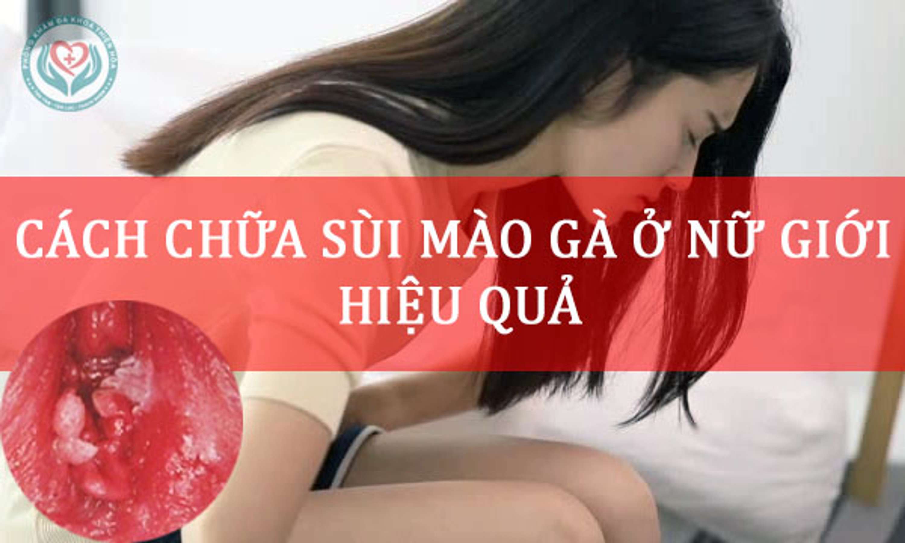 Top 3 cách chữa sùi mào gà ở nữ giới hiệu quả chị em nên biết by Phòng Hòa