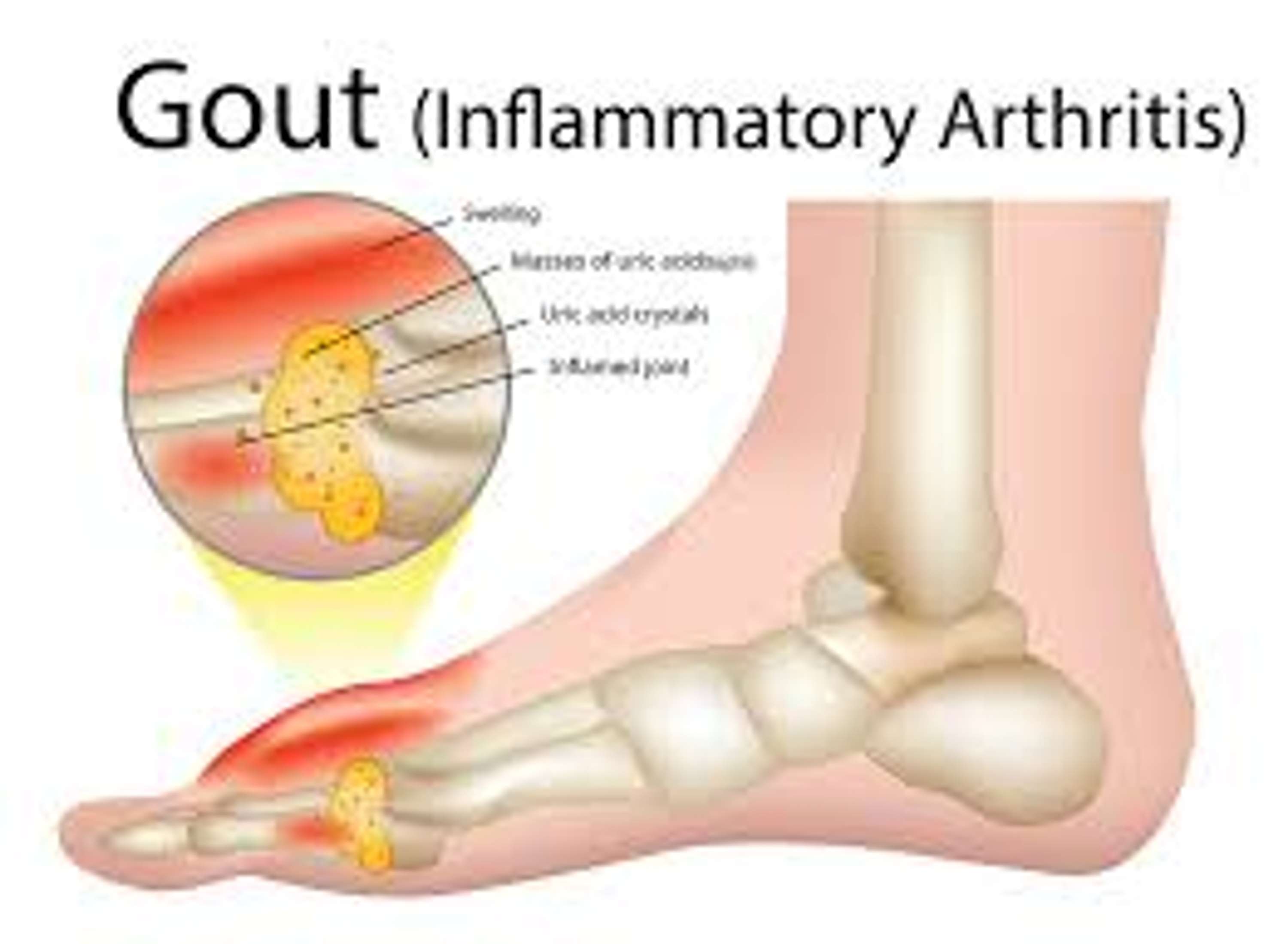 The End Of Gout PDF Book & Diet By Shelly Manning by erawer awlove