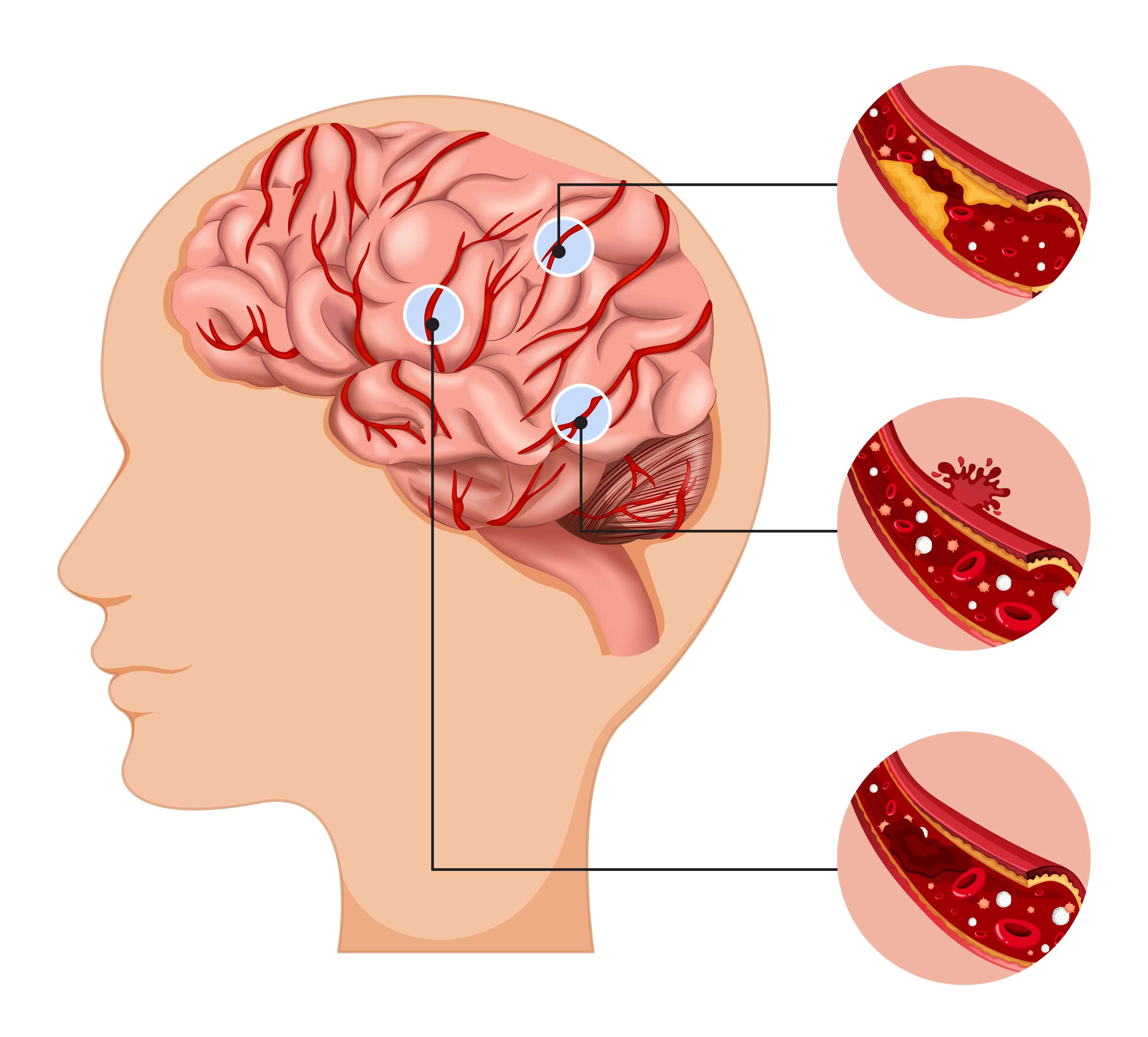 Navigating the Complexity: Understanding Different Types of Brain Tumors and the Role of Twinkling Feeds in Supportive Nutrition by isabella joey