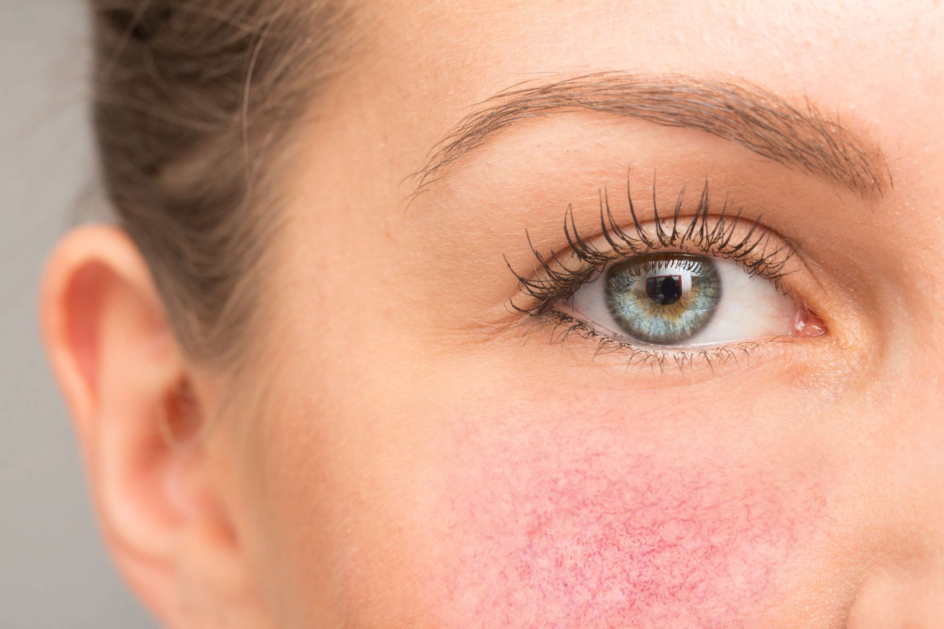 Rosacea Treatment Cost in Dubai & Abu Dhabi by skincare in dubai