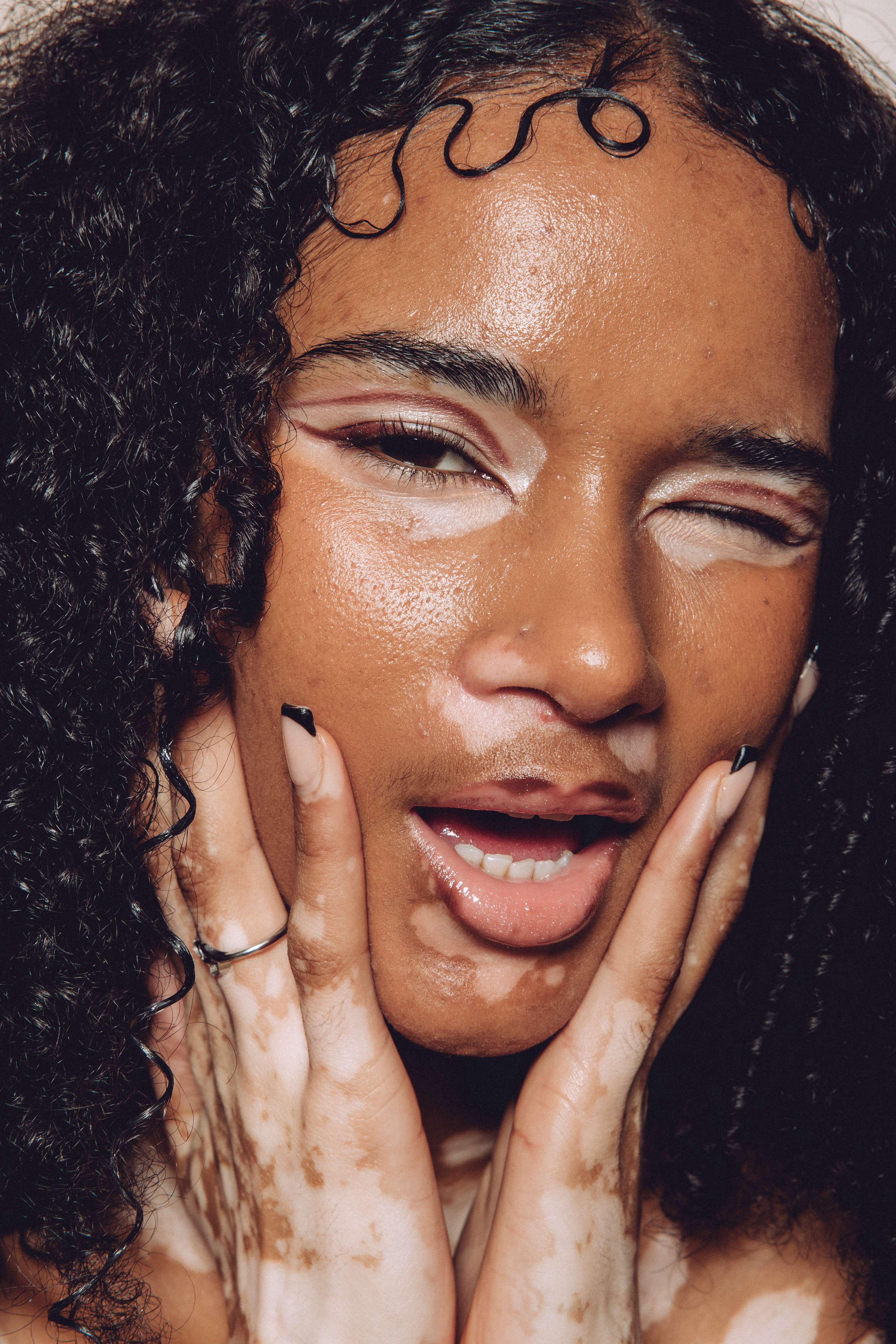 Vitiligo - an ongoing project by Kaye Ford