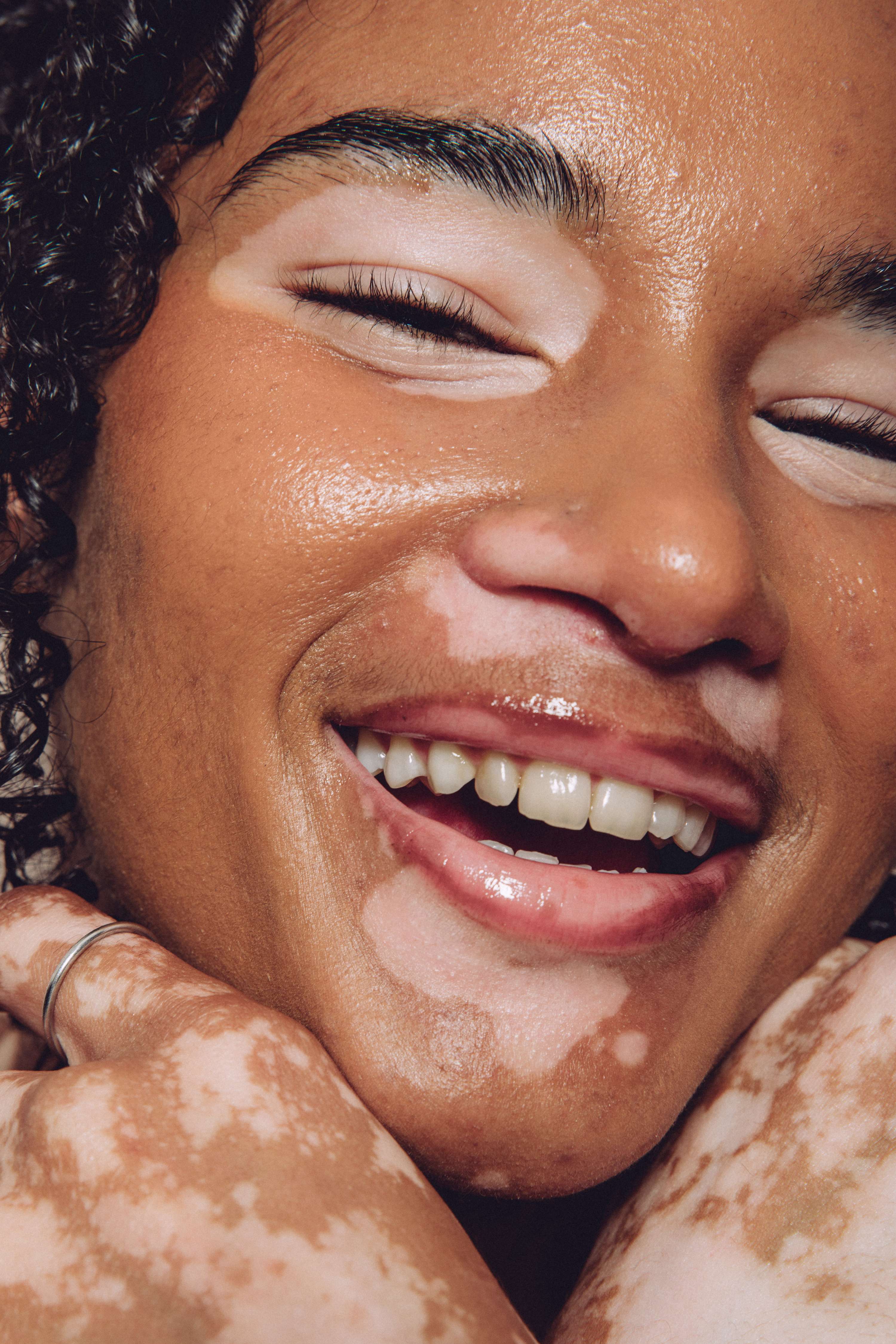 Vitiligo - an ongoing project by Kaye Ford