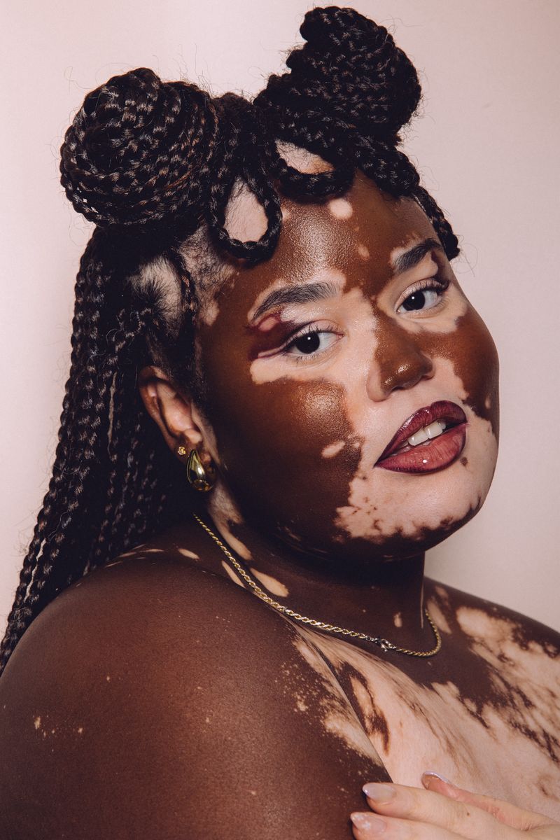 Vitiligo - an ongoing project by Kaye Ford