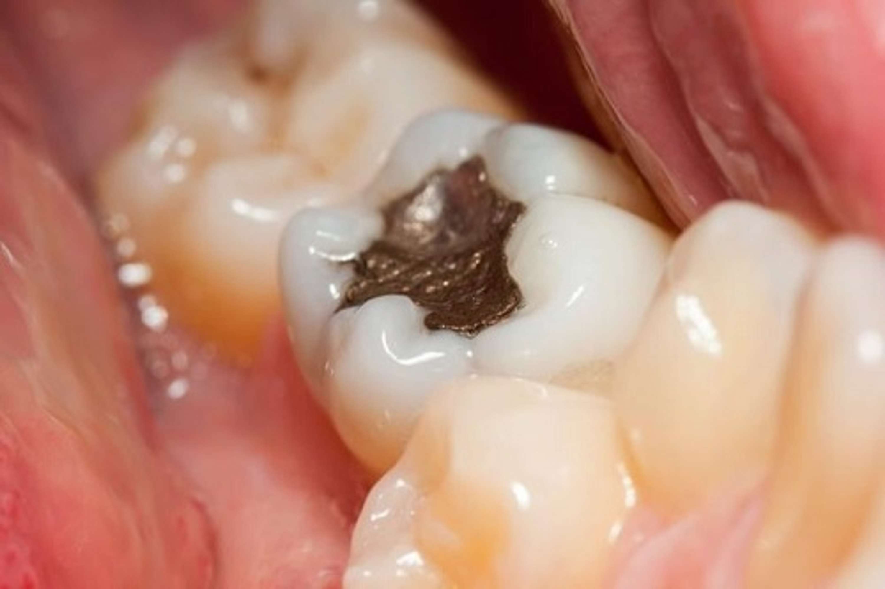 Cavities and Composite Fillings by Cosmetic Smile